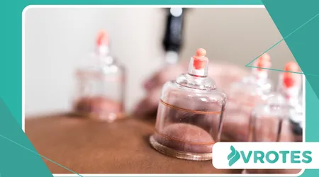 cupping therapy