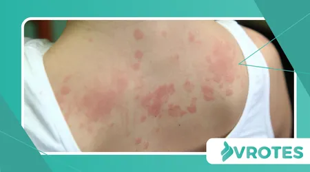 Menopause and Increased Allergic Responses