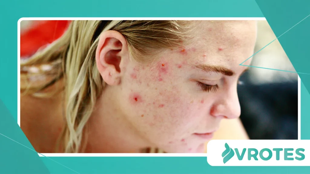managing menopausal acne 