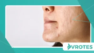 Managing Menopausal Acne Without Harsh Chemicals