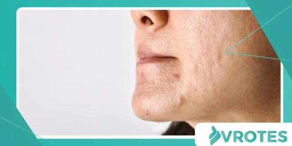 Managing Menopausal Acne Without Harsh Chemicals