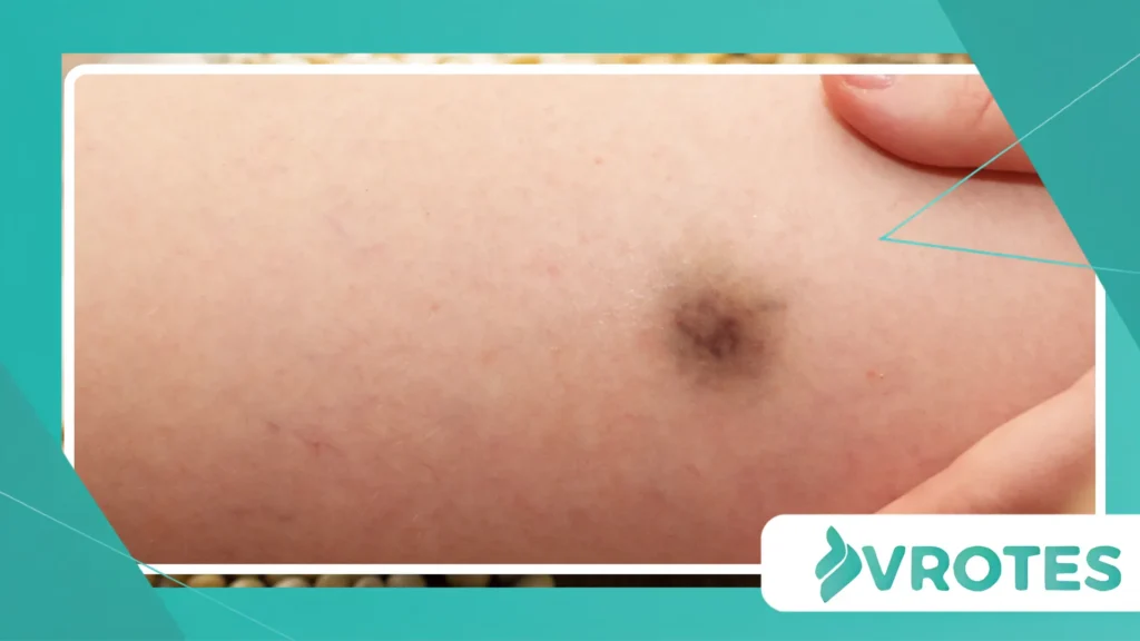 Random Bruising